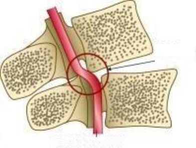 Ваил Артерия синдрому