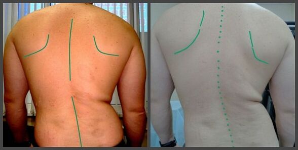 Омуртканын омуртканын ийри