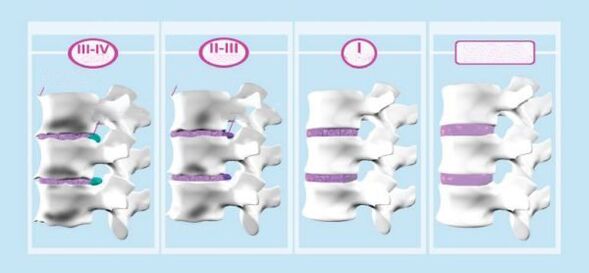 Оста-Остеохондриздин этаптары