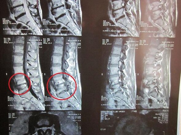 Остео, софондриз диагнозу