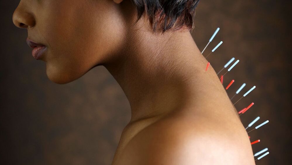 Остеофондриз менен акупунктура