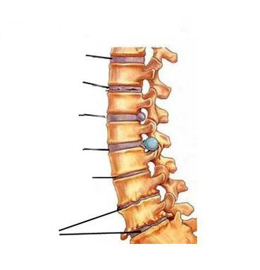 Остофондроз кандайча өнүгөт