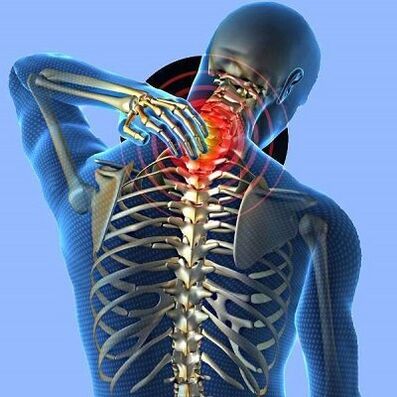 моюн остеохондриз менен моюн оорусу