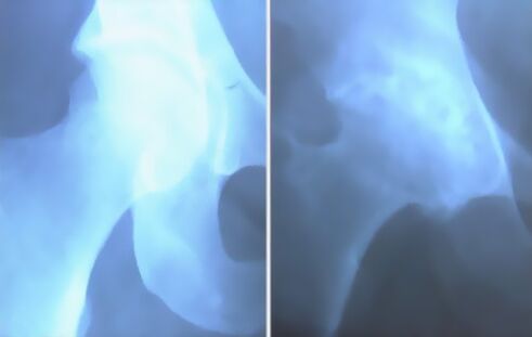 Тизе биргелешкен антрозу