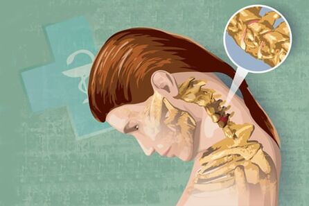 Остеохондриздин симптомдору